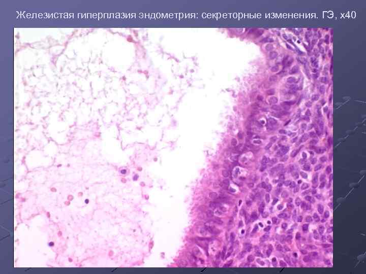 Железистая гиперплазия эндометрия: секреторные изменения. ГЭ, х40 