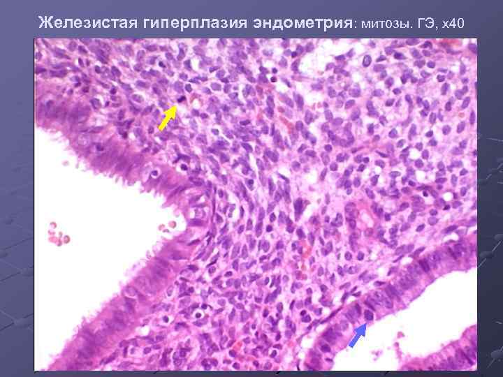 Железистая гиперплазия эндометрия: митозы. ГЭ, х40 