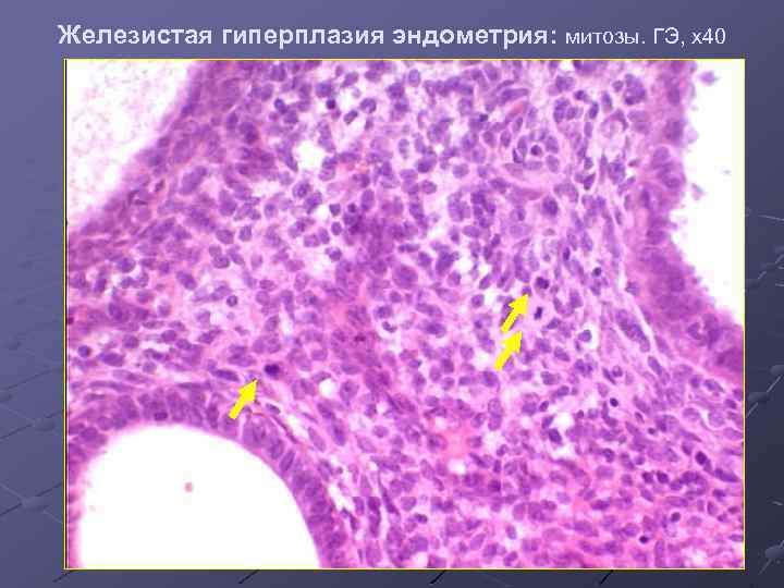 Железистая гиперплазия эндометрия: митозы. ГЭ, х40 