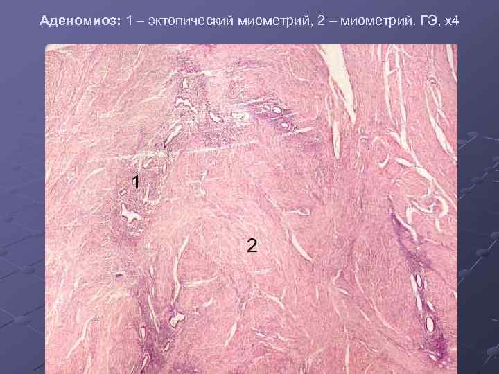 Аденомиоз: 1 – эктопический миометрий, 2 – миометрий. ГЭ, х4 