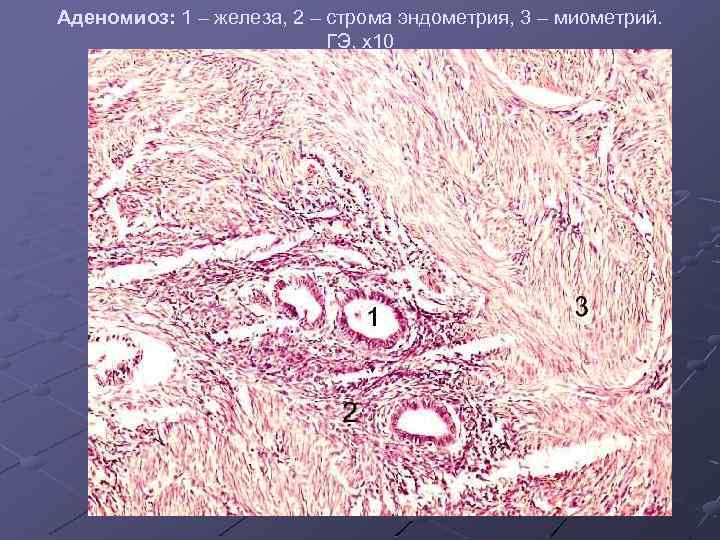 Аденомиоз: 1 – железа, 2 – строма эндометрия, 3 – миометрий. ГЭ, х10 