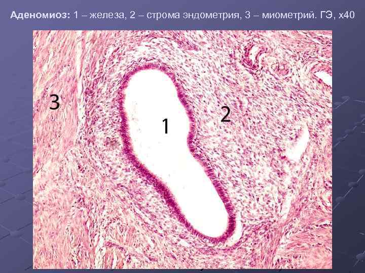 Аденомиоз: 1 – железа, 2 – строма эндометрия, 3 – миометрий. ГЭ, х40 