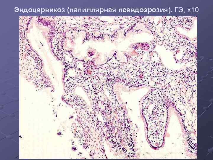 Эндоцервикоз (папиллярная псевдоэрозия). ГЭ, х10 