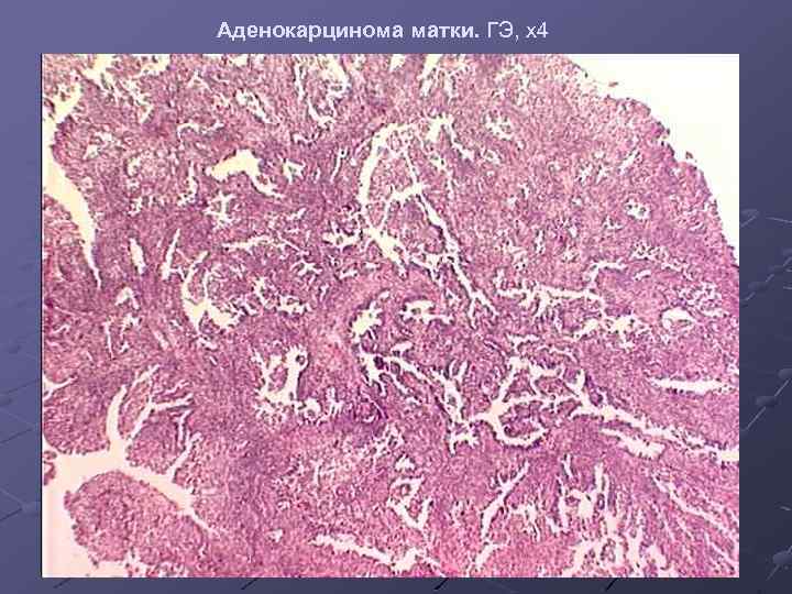 Аденокарцинома матки. ГЭ, х4 