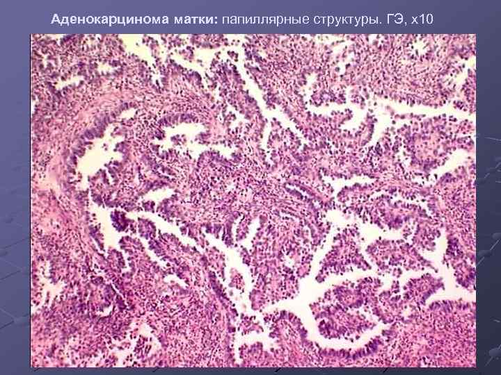 Аденокарцинома матки: папиллярные структуры. ГЭ, х10 
