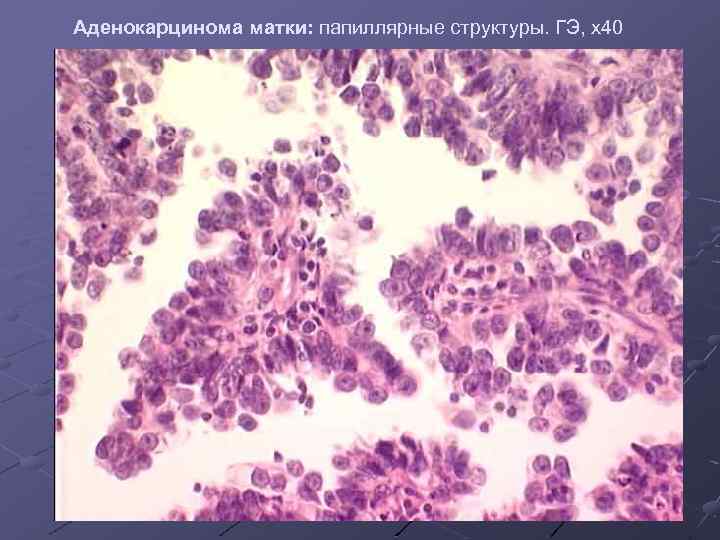 Аденокарцинома матки: папиллярные структуры. ГЭ, х40 