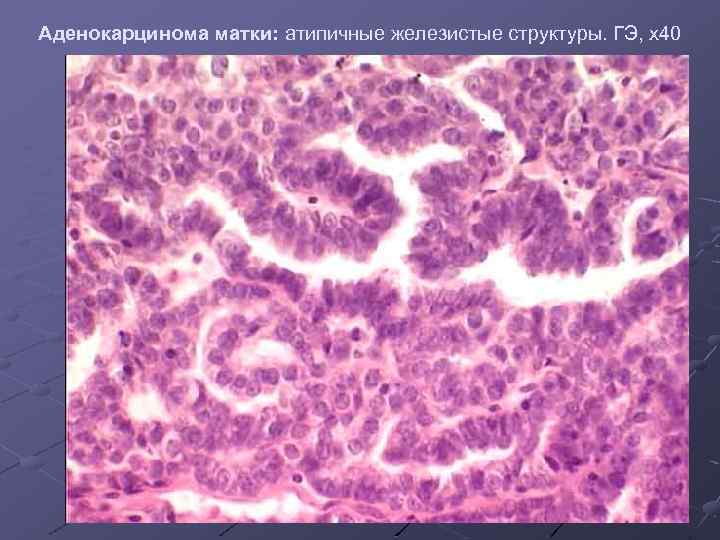 Аденокарцинома матки: атипичные железистые структуры. ГЭ, х40 