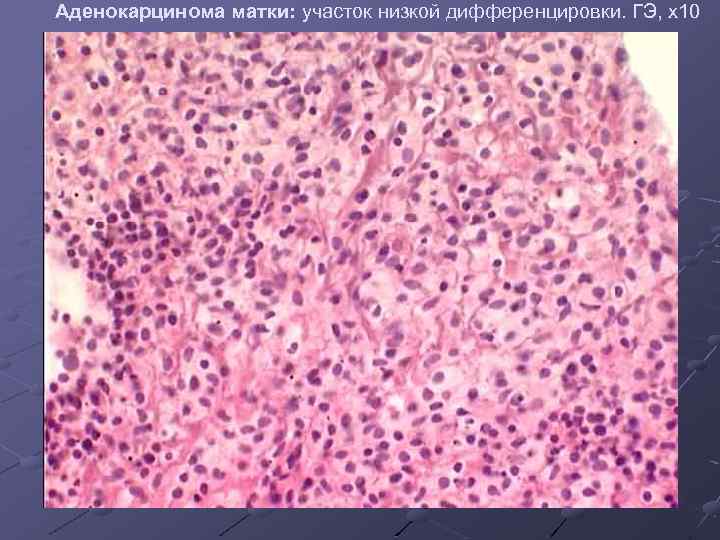 Аденокарцинома матки: участок низкой дифференцировки. ГЭ, х10 