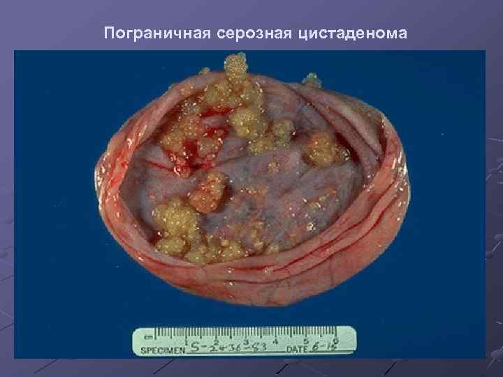 Пограничная серозная цистаденома 