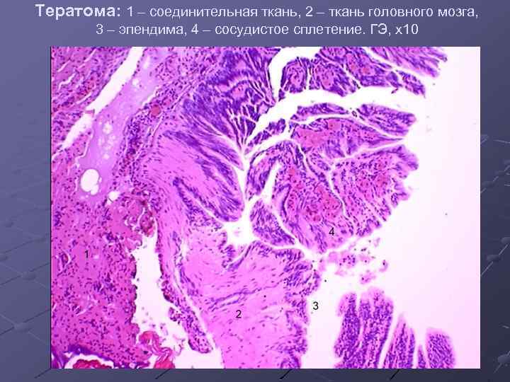 Тератома: 1 – соединительная ткань, 2 – ткань головного мозга, 3 – эпендима, 4