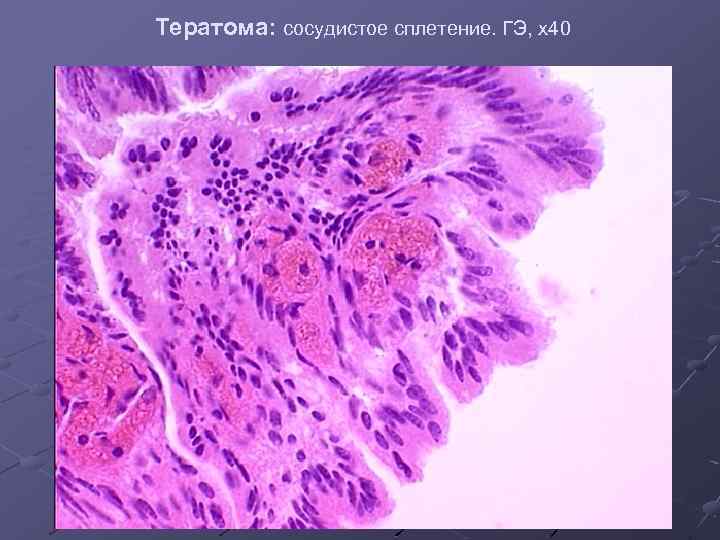 Тератома: сосудистое сплетение. ГЭ, х40 