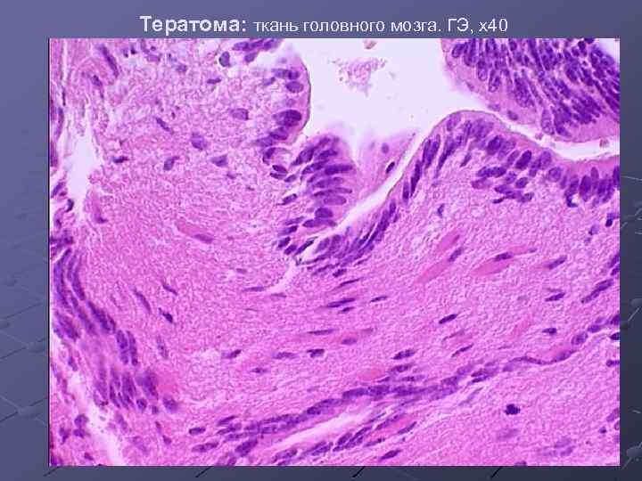 Тератома: ткань головного мозга. ГЭ, х40 