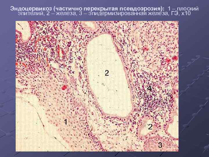 Эндоцервикоз (частично перекрытая псевдоэрозия): 1 – плоский эпителий, 2 – железа, 3 – эпидермизированная