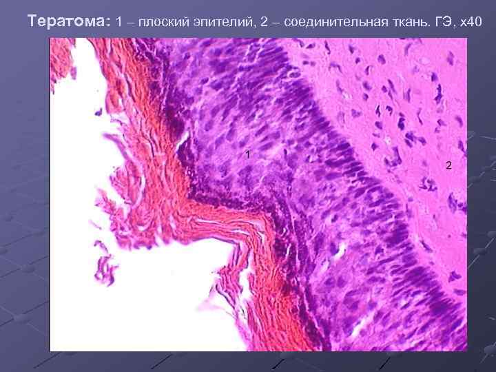 Тератома: 1 – плоский эпителий, 2 – соединительная ткань. ГЭ, х40 