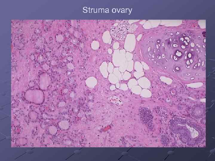 Struma ovary 