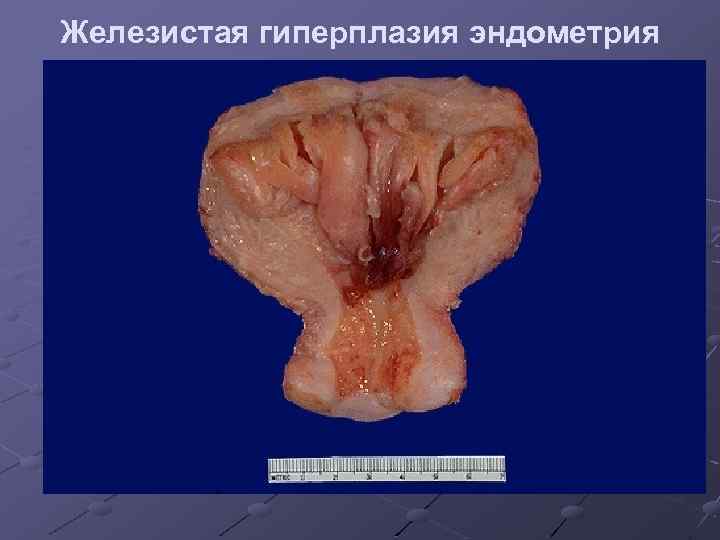 Железистая гиперплазия эндометрия 