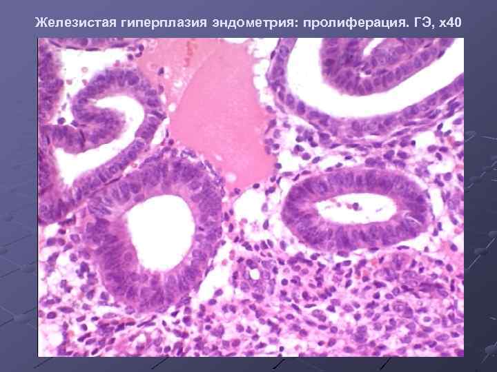 Железистая гиперплазия эндометрия: пролиферация. ГЭ, х40 