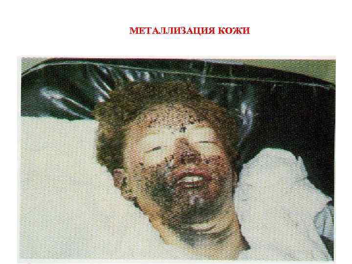 МЕТАЛЛИЗАЦИЯ КОЖИ 