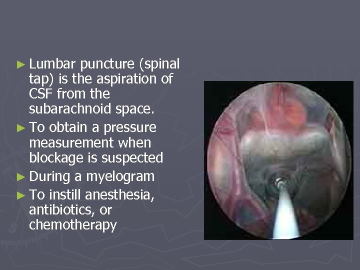 ► Lumbar puncture (spinal tap) is the aspiration of CSF from the subarachnoid space.