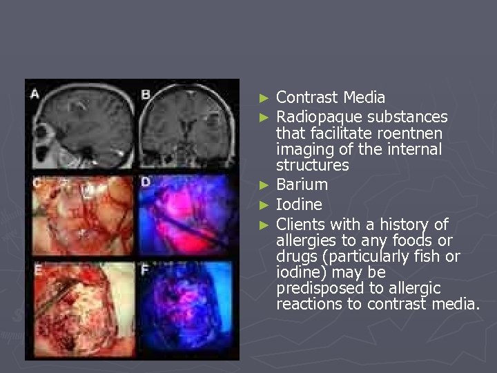 Contrast Media Radiopaque substances that facilitate roentnen imaging of the internal structures ► Barium