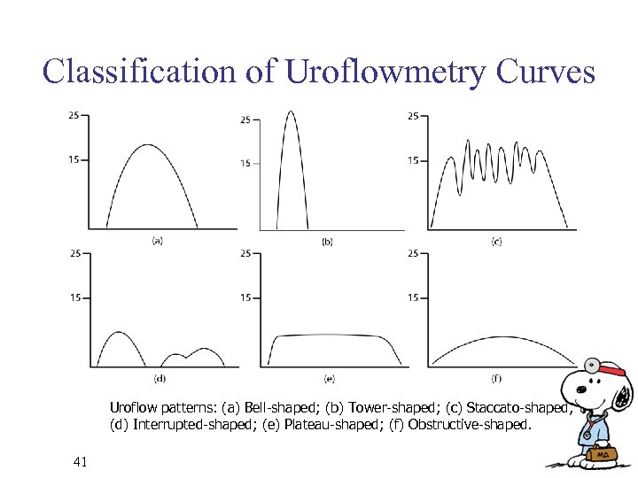 Classification of Uroflowmetry Curves Uroflow patterns: (a) Bell-shaped; (b) Tower-shaped; (c) Staccato-shaped; (d) Interrupted-shaped;