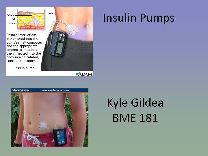 Insulin Pumps Kyle Gildea BME 181 
