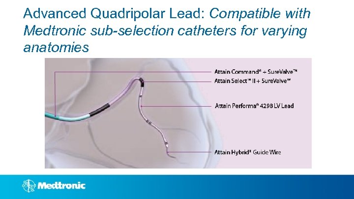 Advanced Quadripolar Lead: Compatible with Medtronic sub-selection catheters for varying anatomies 