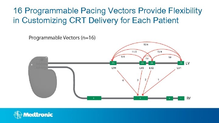 16 Programmable Pacing Vectors Provide Flexibility in Customizing CRT Delivery for Each Patient 