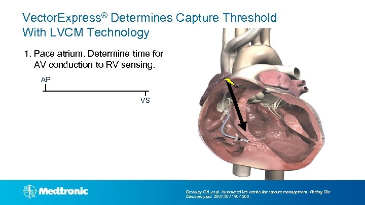Vector. Express® Determines Capture Threshold With LVCM Technology 1. Pace atrium. Determine time for