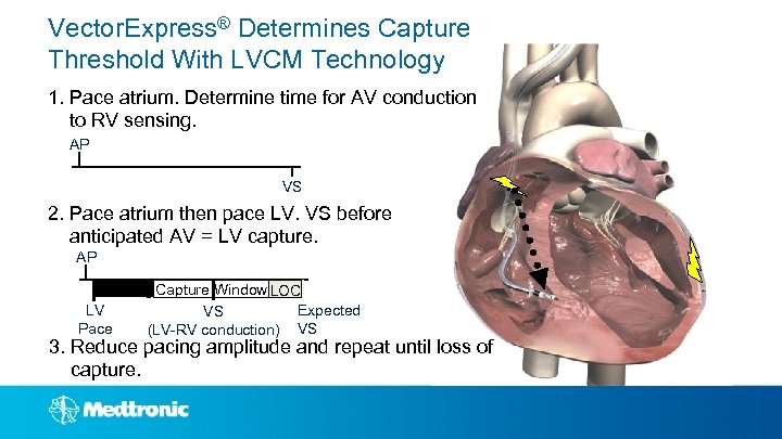 Vector. Express® Determines Capture Threshold With LVCM Technology 1. Pace atrium. Determine time for