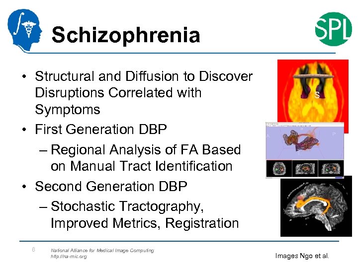 Schizophrenia • Structural and Diffusion to Discover Disruptions Correlated with Symptoms • First Generation