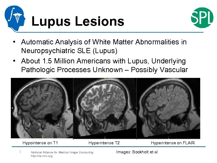 Lupus Lesions • Automatic Analysis of White Matter Abnormalities in Neuropsychiatric SLE (Lupus) •