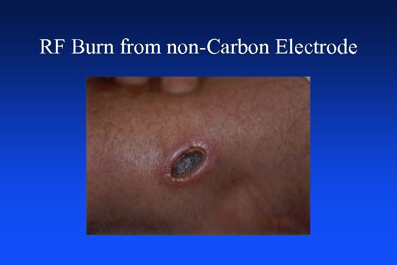 RF Burn from non-Carbon Electrode 