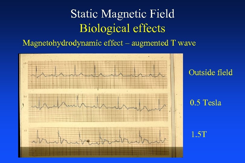 Static Magnetic Field Biological effects Magnetohydrodynamic effect – augmented T wave Outside field 0.