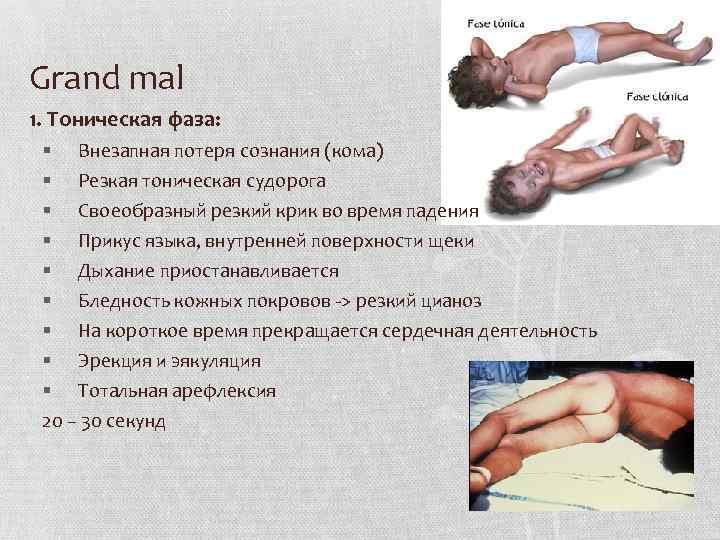 Grand mal 1. Тоническая фаза: § Внезапная потеря сознания (кома) § Резкая тоническая судорога