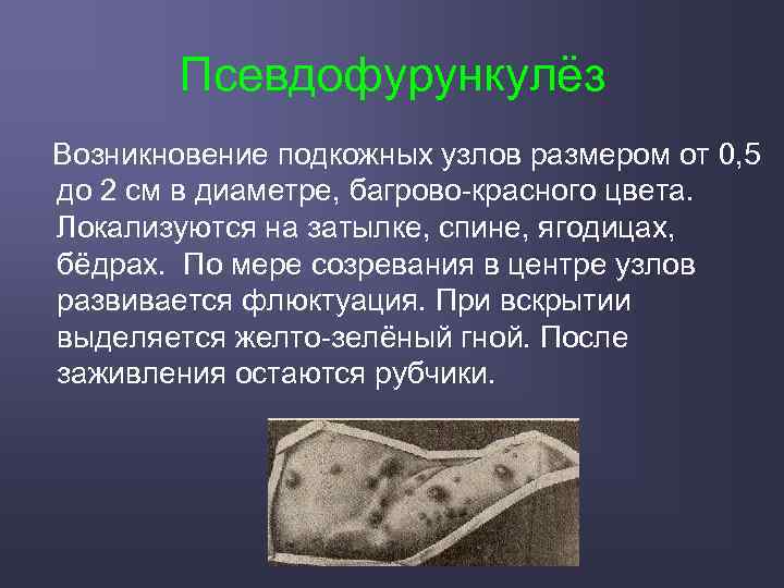 Псевдофурункулёз Возникновение подкожных узлов размером от 0, 5 до 2 см в диаметре, багрово-красного