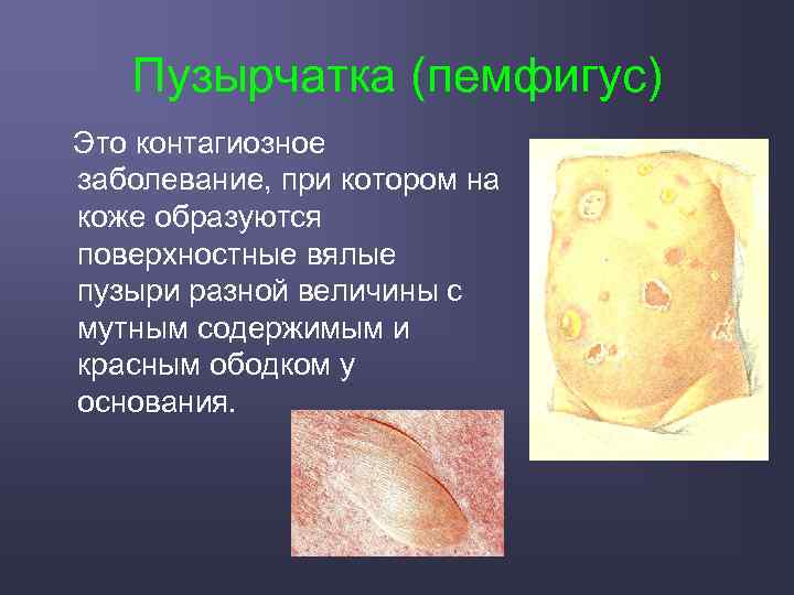 Пузырчатка (пемфигус) Это контагиозное заболевание, при котором на коже образуются поверхностные вялые пузыри разной