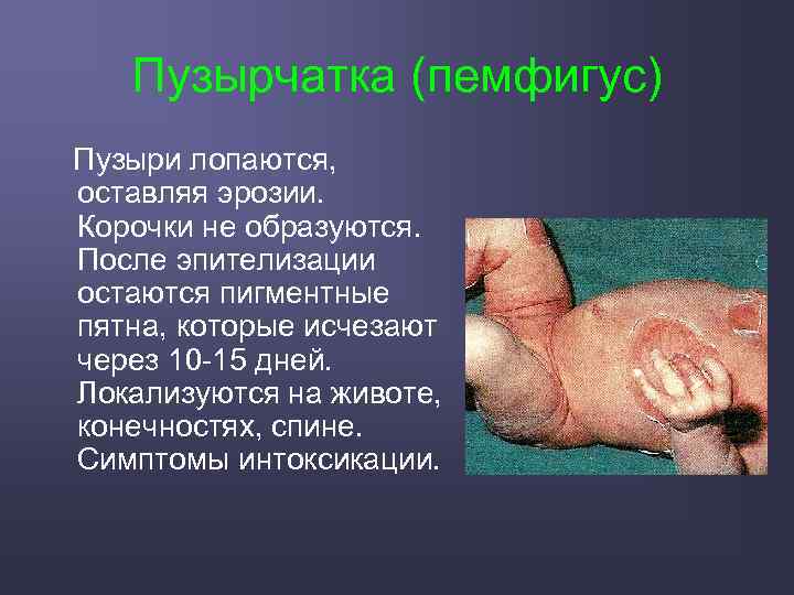 Пузырчатка (пемфигус) Пузыри лопаются, оставляя эрозии. Корочки не образуются. После эпителизации остаются пигментные пятна,