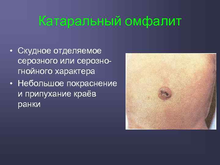 Катаральный омфалит • Скудное отделяемое серозного или серозногнойного характера • Небольшое покраснение и припухание