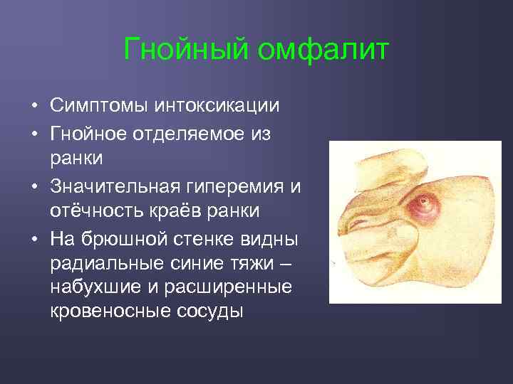 Гнойный омфалит • Симптомы интоксикации • Гнойное отделяемое из ранки • Значительная гиперемия и