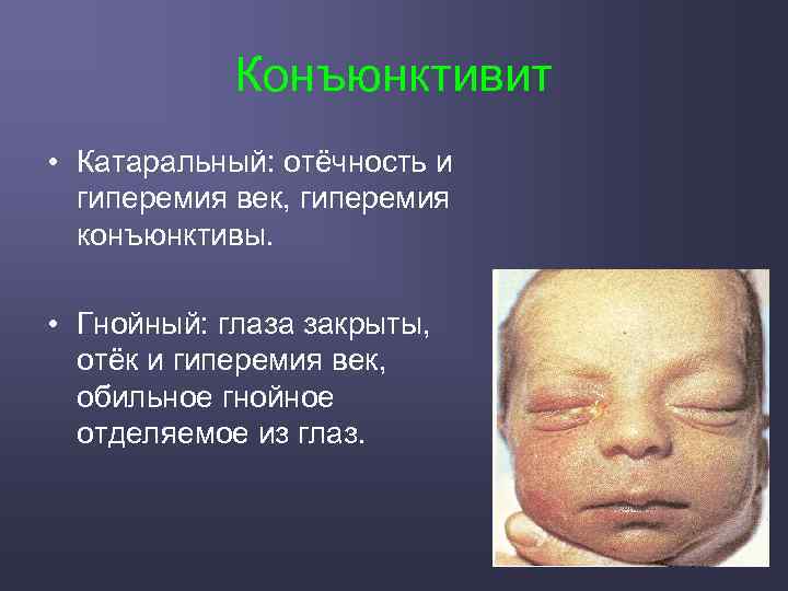 Конъюнктивит • Катаральный: отёчность и гиперемия век, гиперемия конъюнктивы. • Гнойный: глаза закрыты, отёк
