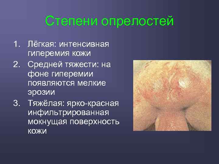 Степени опрелостей 1. Лёгкая: интенсивная гиперемия кожи 2. Средней тяжести: на фоне гиперемии появляются