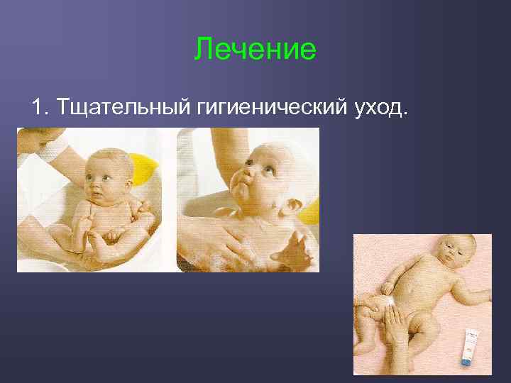 Лечение 1. Тщательный гигиенический уход. 