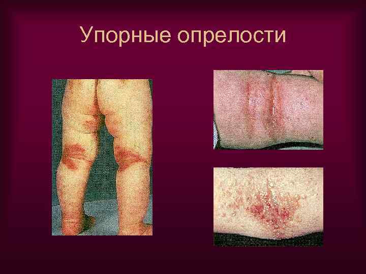 Упорные опрелости 