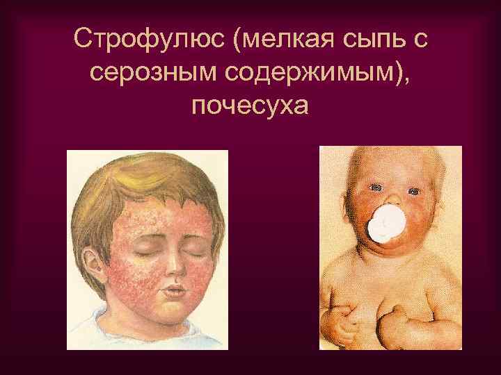 Строфулюс (мелкая сыпь с серозным содержимым), почесуха 