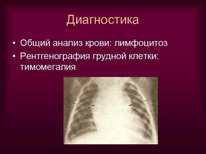 Диагностика • Общий анализ крови: лимфоцитоз • Рентгенография грудной клетки: тимомегалия 