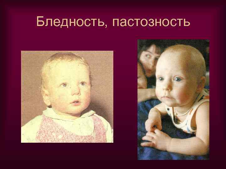 Бледность, пастозность 