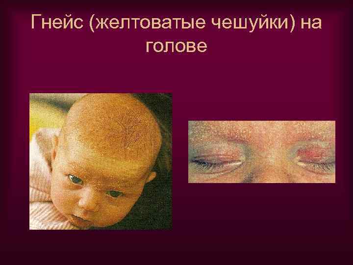 Гнейс (желтоватые чешуйки) на голове 