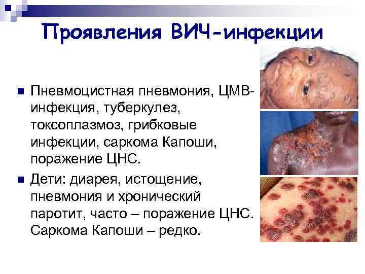 Проявления ВИЧ-инфекции n n Пневмоцистная пневмония, ЦМВинфекция, туберкулез, токсоплазмоз, грибковые инфекции, саркома Капоши, поражение