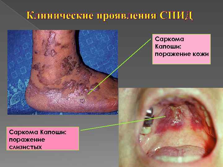 Клинические проявления СПИД Саркома Капоши: поражение кожи Саркома Капоши: поражение слизистых 